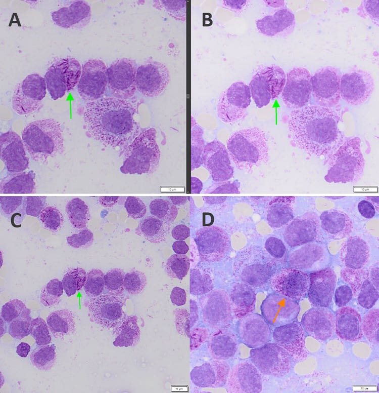 Imaging eines kompletten Objektträgers mit myeloischen Blastenzellen und Auerstäbchen