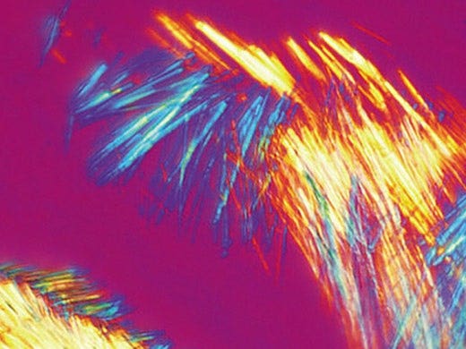 Einfache Gichtuntersuchung