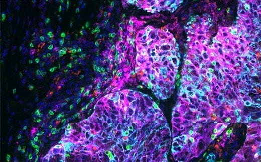 Lung tissue stained with Ultivue’s PD-L1 multiplex kit; DAPI: nuclear counterstain, FITC: CD8, TRITC: CD68, Cy5: PD-L1, Cy7: panCK. Imaged at 20X on a VS200 scanner. Image data courtesy of Ultivue, Inc.