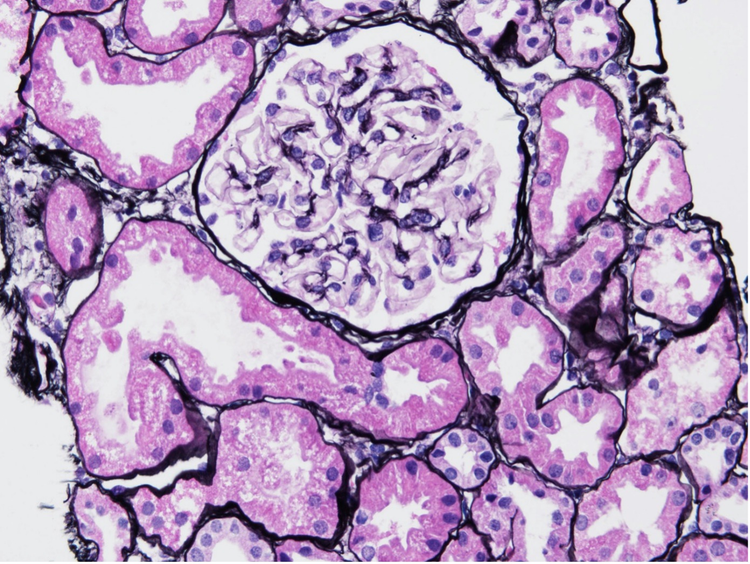 Figure 1. LN class 1 kidney sample biopsy sample, stained with Jonas silver stain.