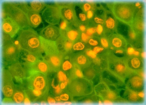 Human Salivary Gland Adenocarcinoma