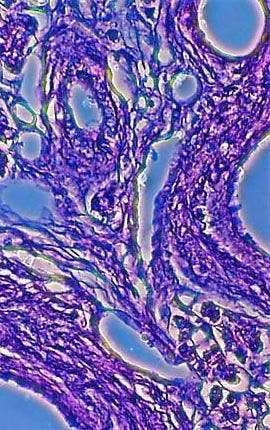 Diabetes Mellitus