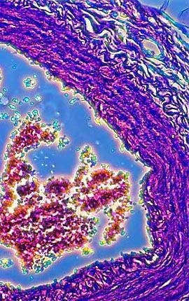 Human Breast Adenocarcinoma