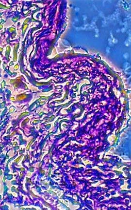 Bronchiogenic Carcinoma