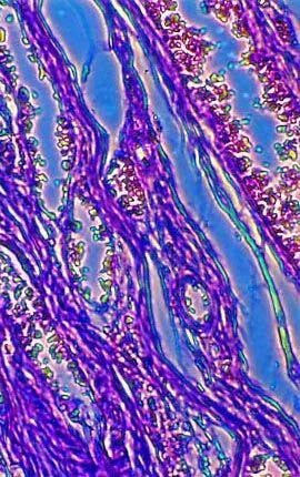 Lymph Node Carcinoma