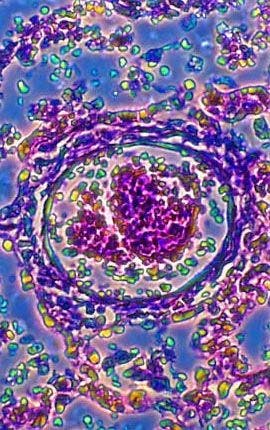 Bronchial Pneumonia