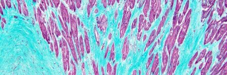 Infarto de miocardio observado bajo el microscopio