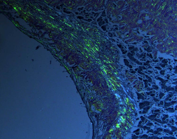 Tejido humano con amiloidosis visto bajo el microscopio