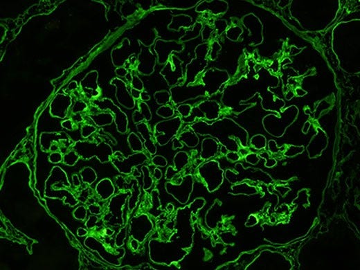 Muestra de glomérulo renal