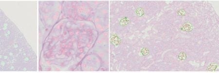 Three slide sample images showing TruAI labeled and counted glomeruli and renal nuclei
