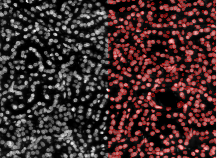 Segmentation d'image de cellules tumorales de tissu humain par apprentissage profond