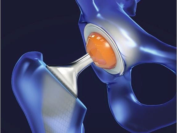 Articolazione artificiale