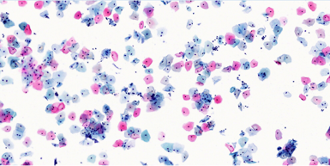 Citologia su strato sottile (ThinPrep Pap test)