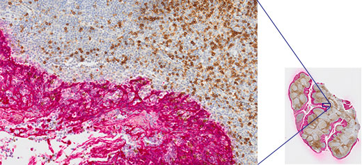 扁桃腺CD3（rm）、ImmPRESS Reagent（HRP）Anti-Mouse IgG Immpact DAB（茶色）、AE1/AE3（m）ImmPRESS（AP）（HRP）Anti-Rabbit IgG Immpact Vector Red（赤色）。 Hematoxylin QS（青色）による対比染色。