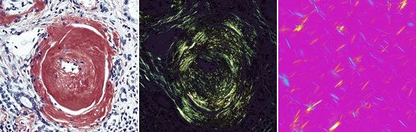 図16 組織切片のアミロイド観察と尿酸ナトリウムの偏光観察