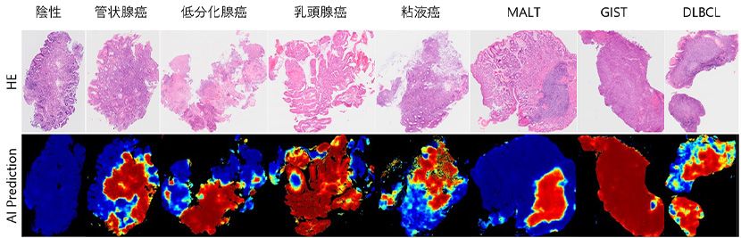 胃がんを対象としたAI病理診断支援ソフトウェアの汎用性の向上に成功