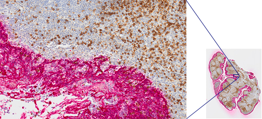 Tonsil CD3(rm), ImmPRESS Reagent(HRP), Anti-Mouse IgG Immpact DAB(갈색), AE1/AE3(m), ImmPRESS(AP)(HRP), Anti-Rabbit IgG Immpact Vector Red(적색). Hematoxylin QS(블루)로 대조염색. 이미지 데이터 제공: Vector Labs.